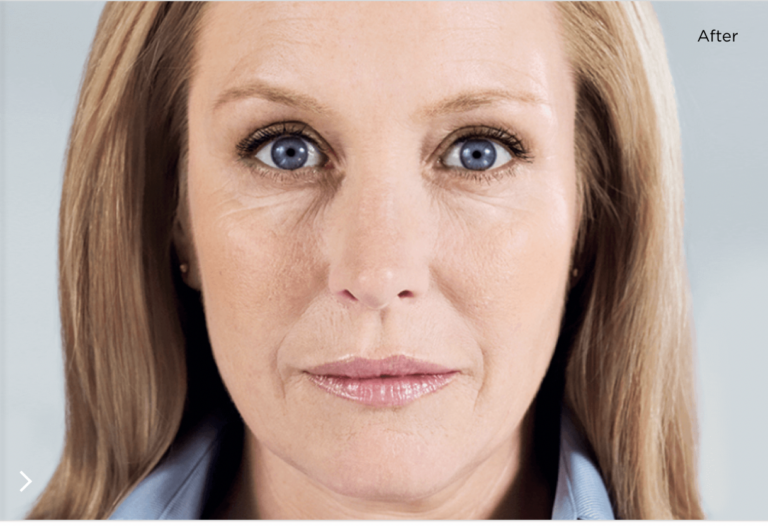 After Sculptra Persona Medical Aesthetics