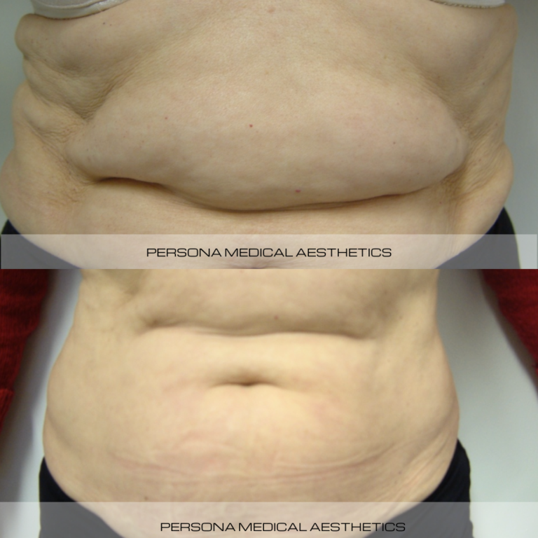 Aqualyc before & after Persona Medical