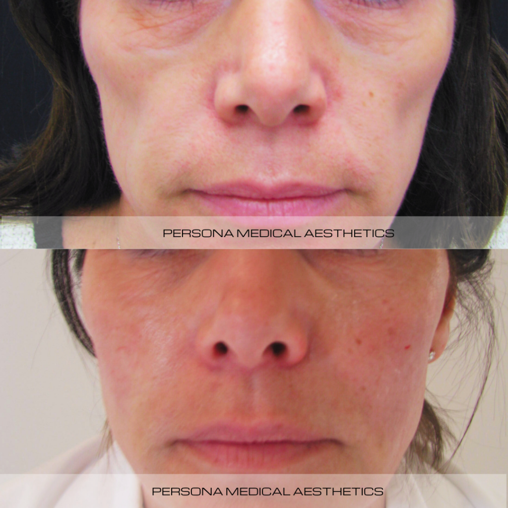 cheek filler offers a non-surgical solution that can effectviely restore lost volume and enhance facial contours. Using advanced dermal fillers, we can reintroduce structure and give lift, to help create a youthful curve.