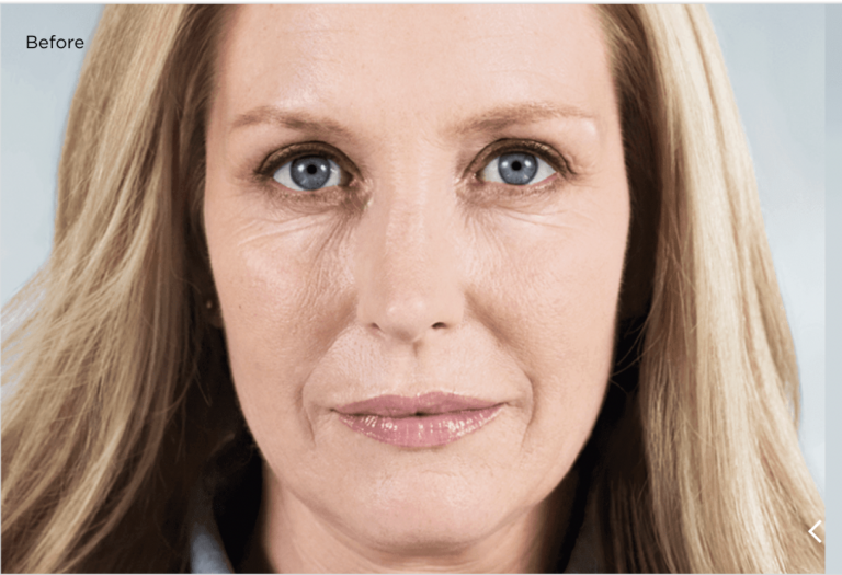 Before Sculptra Persona Medical Aesthetics