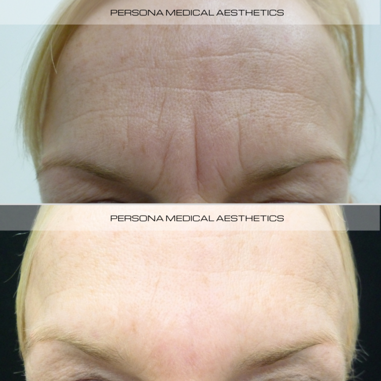 Before and After Anti Wrinkle
