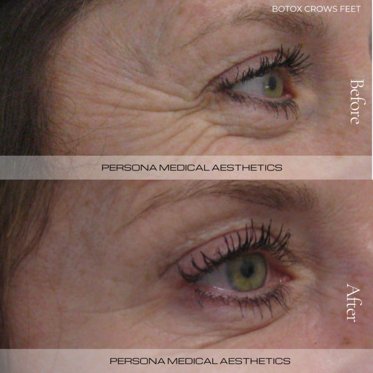 Before and After Botox