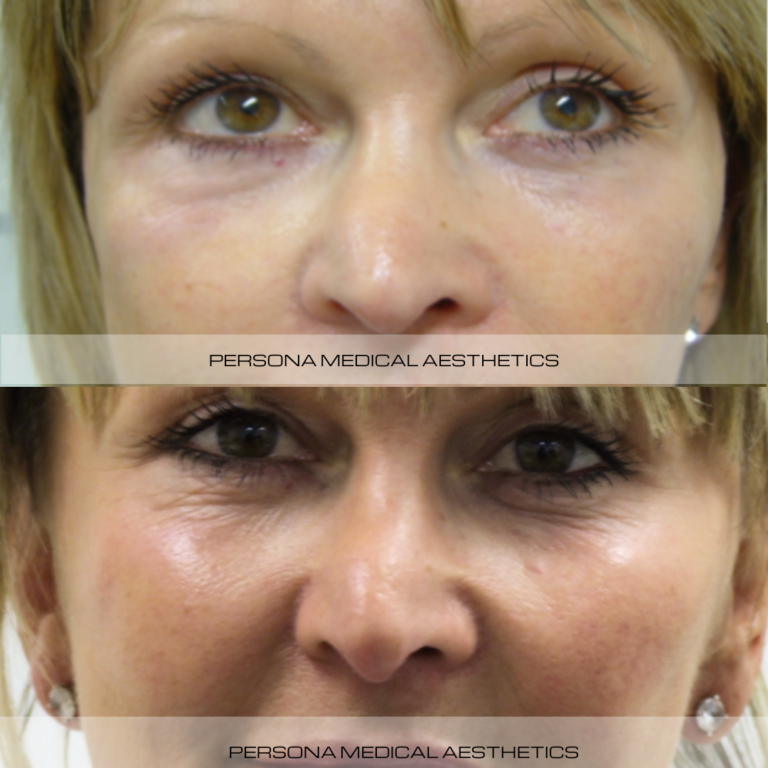 Before and After Cheeks