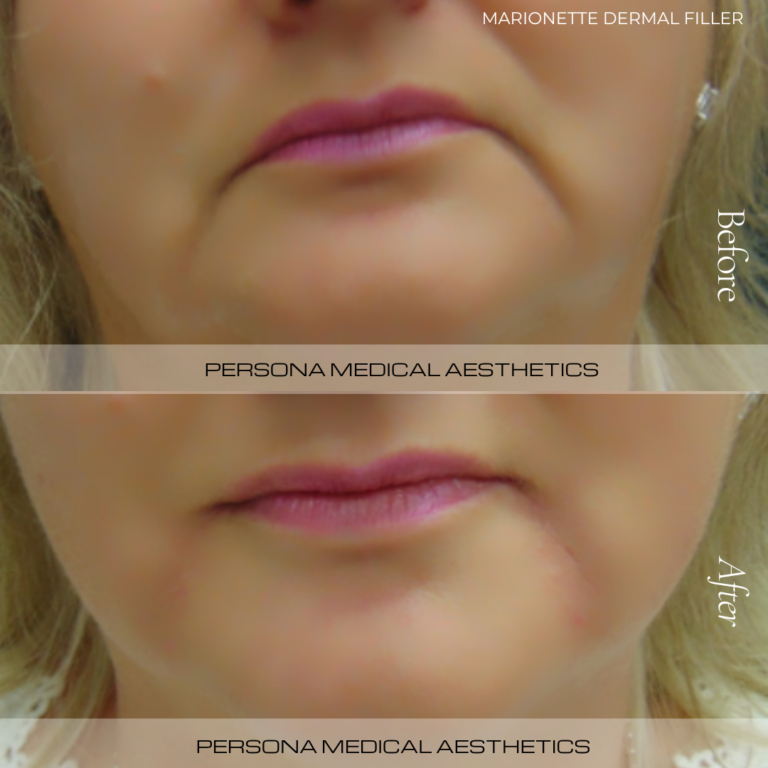 Before and After Dermal Fillers