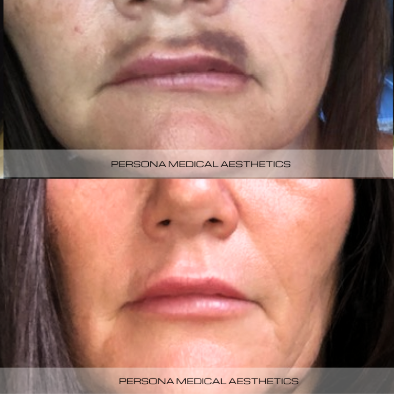 Before and After Hyalase