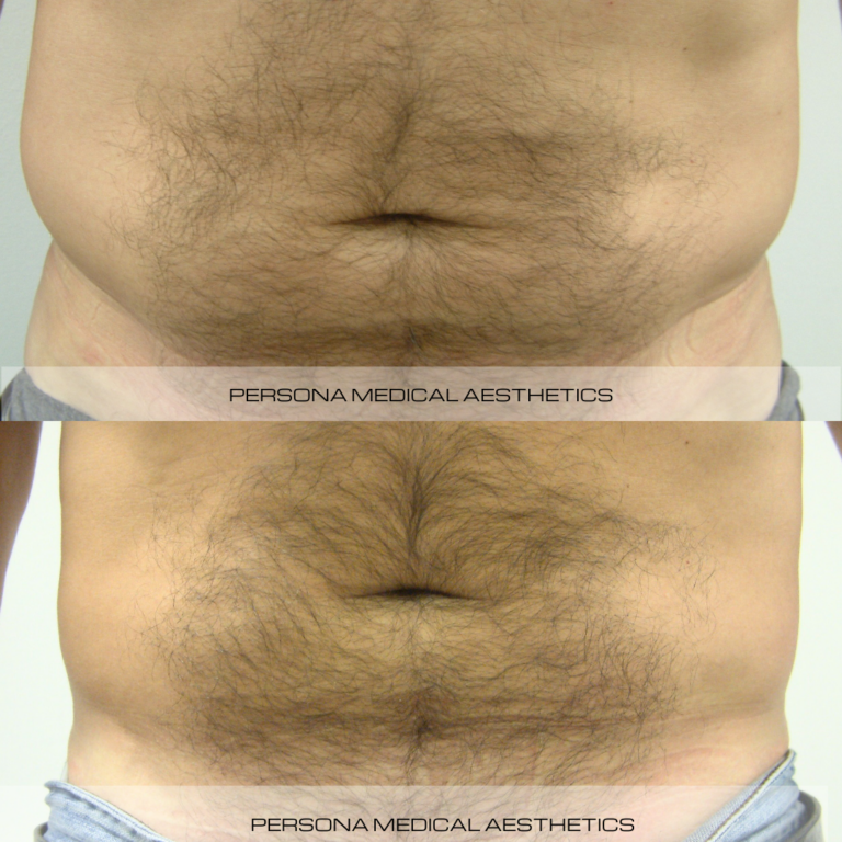 Before and After Instagram Aqualyx Persona Medical