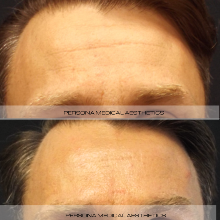 Before and After Instagram Botox Man