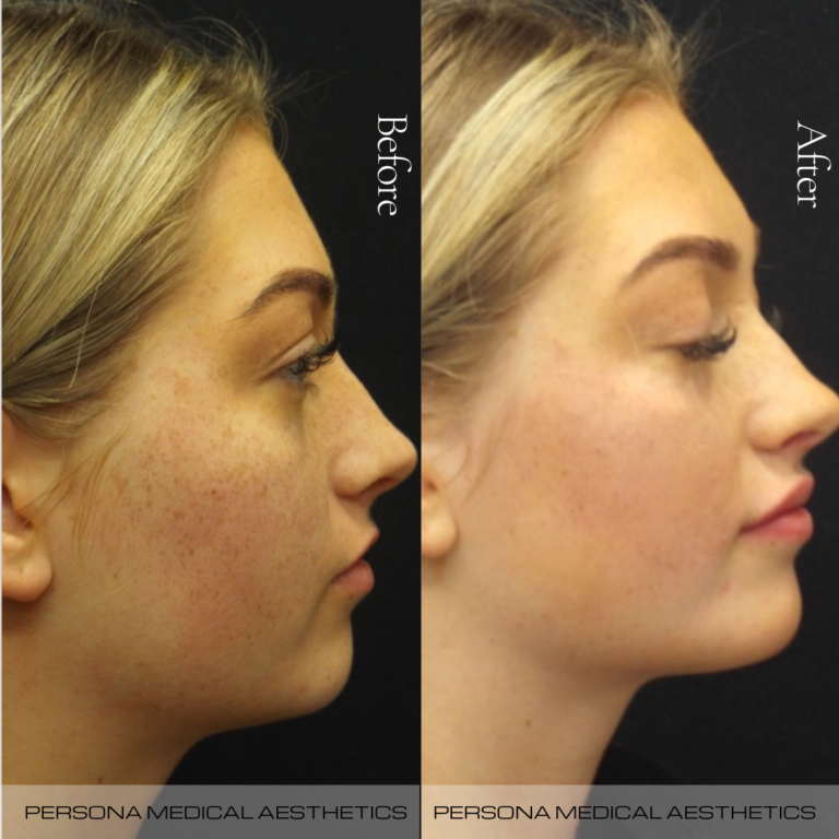 Before and After Jaw