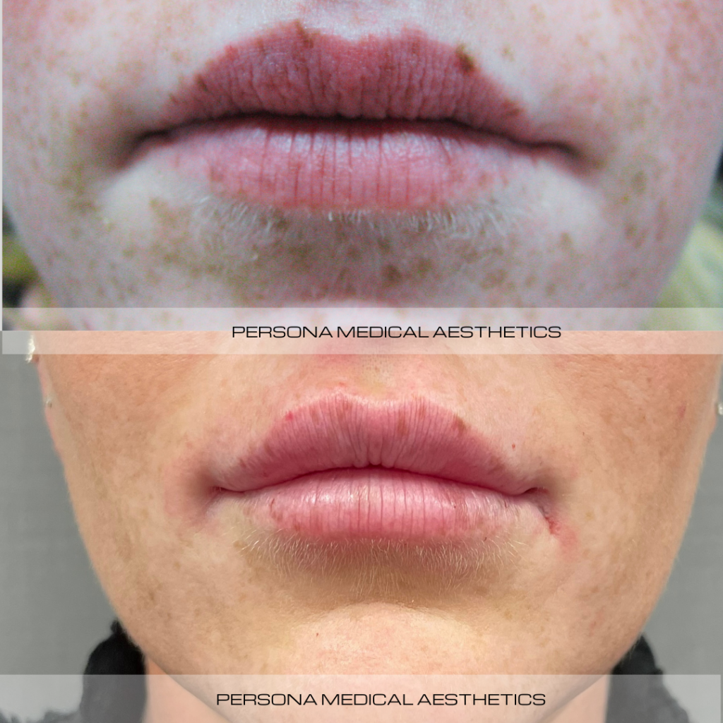 Lip fillers and Russian lips at Persona Medical Aesthetics have become increasingly popular. They are a quick and easy way to add plumpness and volume to your lips. Our skilled medical practitioners can add volume, definition, and fullness to your individual lip shape.