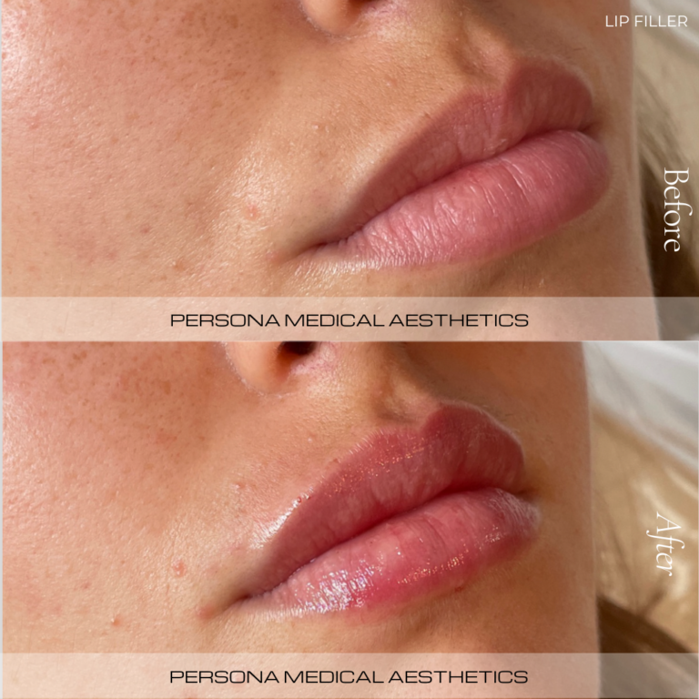 Before and After Lip Filler Persona Medical Aesthetics