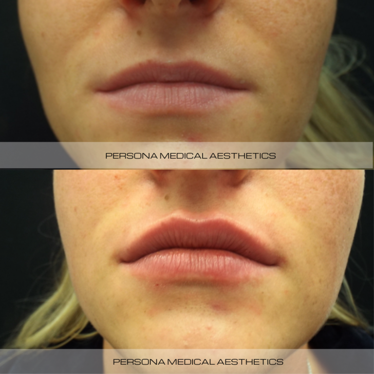 Before and After Lip Persona Medicalpng