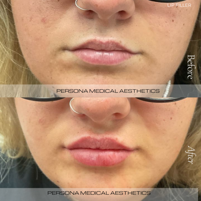 Before and After Lips Persona Medical