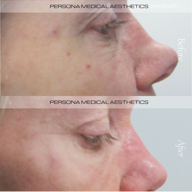 Before and After Nose