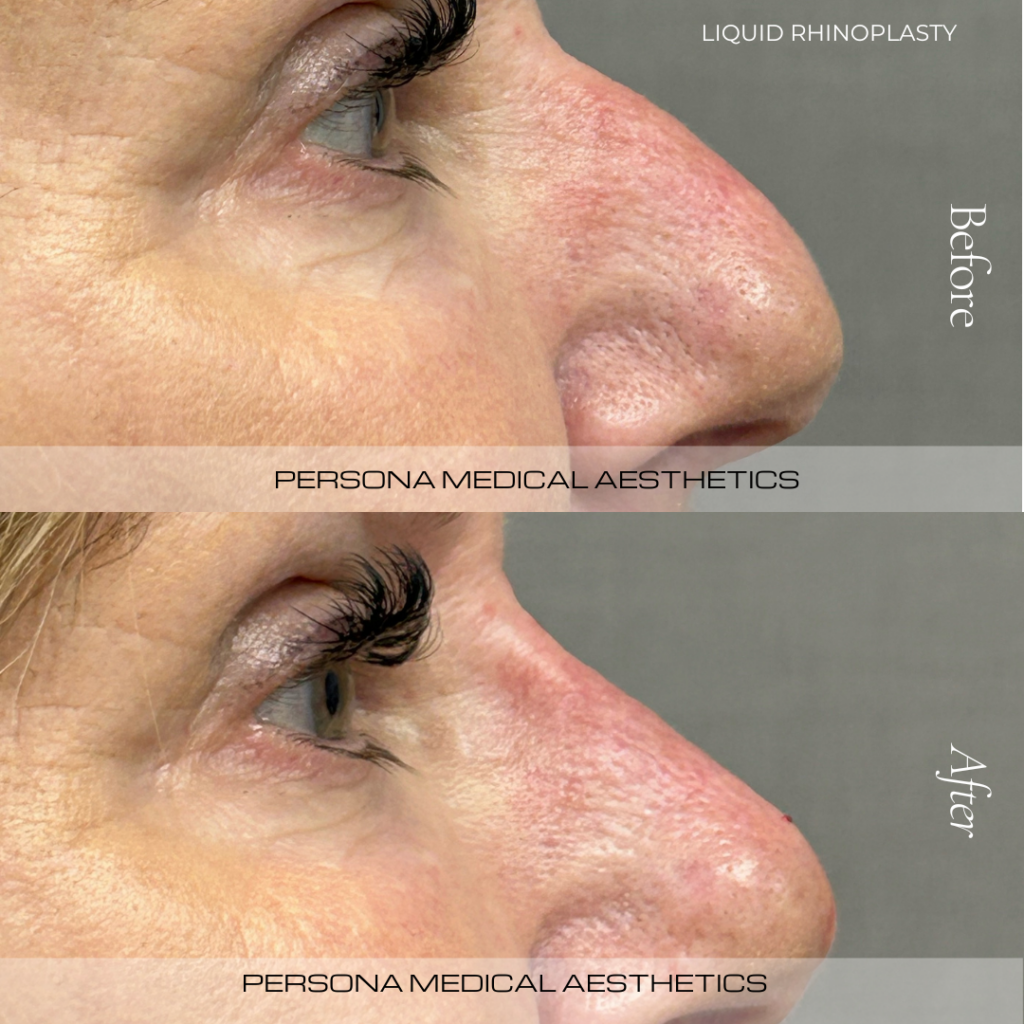 Nose filler, also known as a non-surgical rhinoplasty or 'liquid rhinoplasty', is a minimally invasive procedure that reshapes and enhances the nose using dermal fillers. Instead of surgery, this treatment uses filler to sculpt the nose, correct asymmetry, or smooth out bumps.