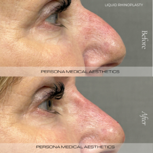 Nose filler, also known as a non-surgical rhinoplasty or 'liquid rhinoplasty', is a minimally invasive procedure that reshapes and enhances the nose using dermal fillers. Instead of surgery, this treatment uses filler to sculpt the nose, correct asymmetry, or smooth out bumps. 