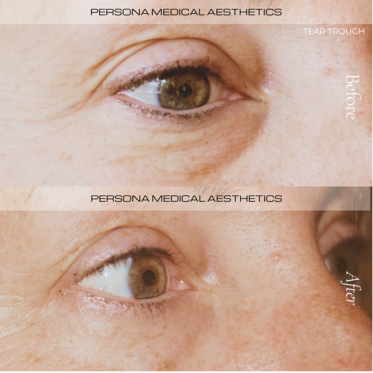 Before and After T Trough Persona Medical
