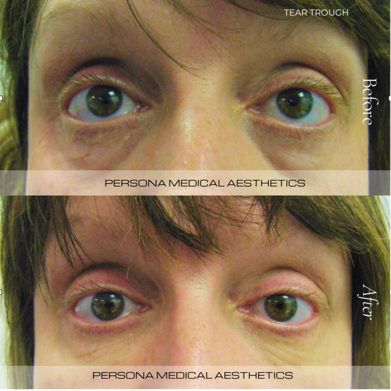 Before and After Tear trough filler