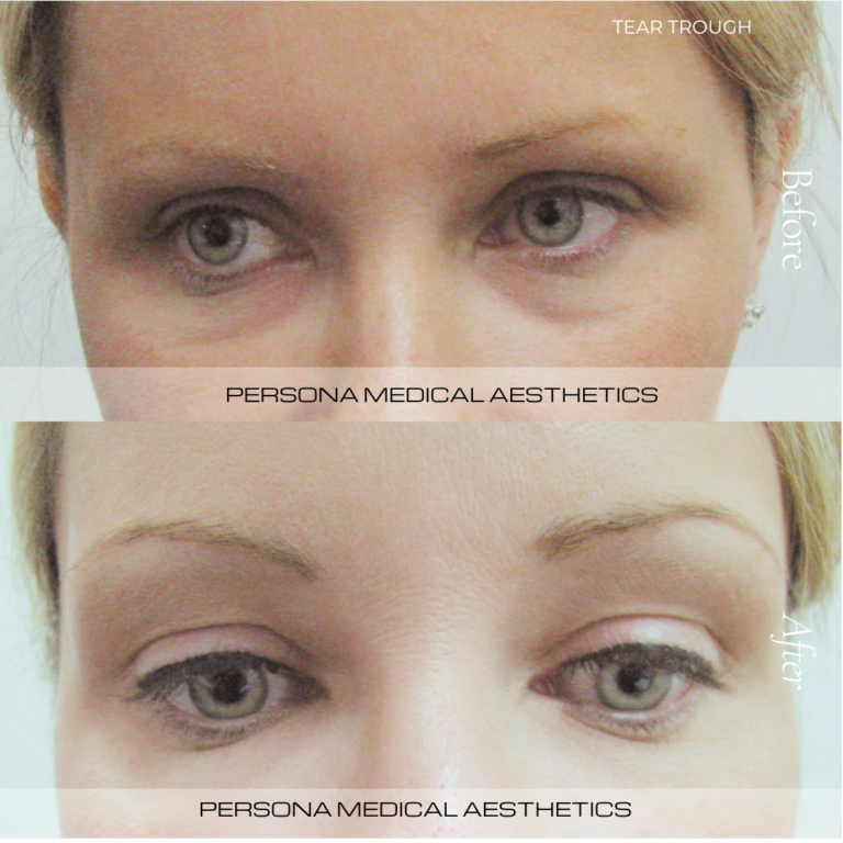 Before and After Tear trough persona medical