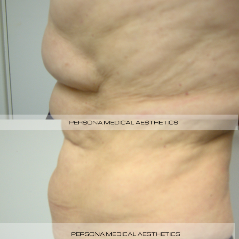 Before and After aqualyx Persona Medical Aesthetics