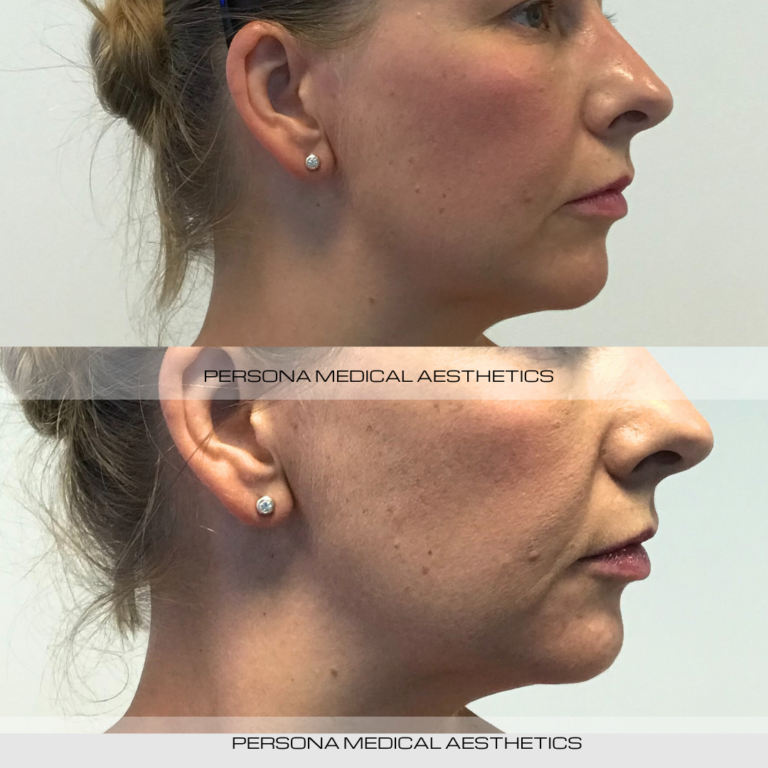 Chin Before & after