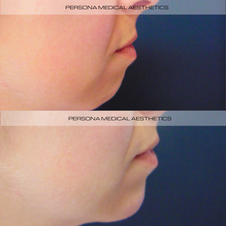 Chin Filler Before & after Persona Medical Aesthetics