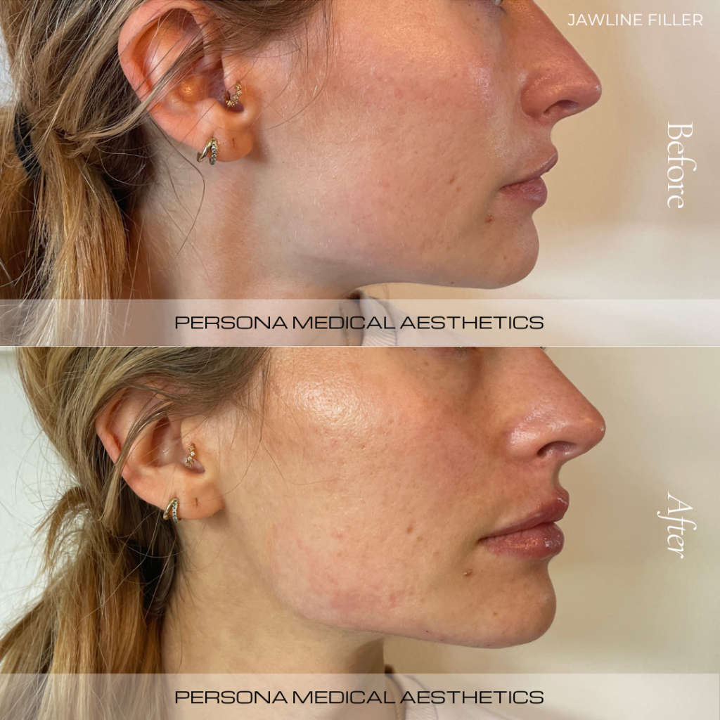 Jawline filler is a non-surgical treatment that enhances the definition, structure, and contour of the jaw.