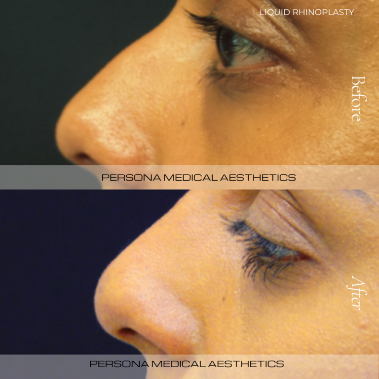 Nose Before & after Persona Medical Aesthetics
