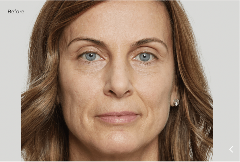 Scupltra Persona Medical Aesthetics