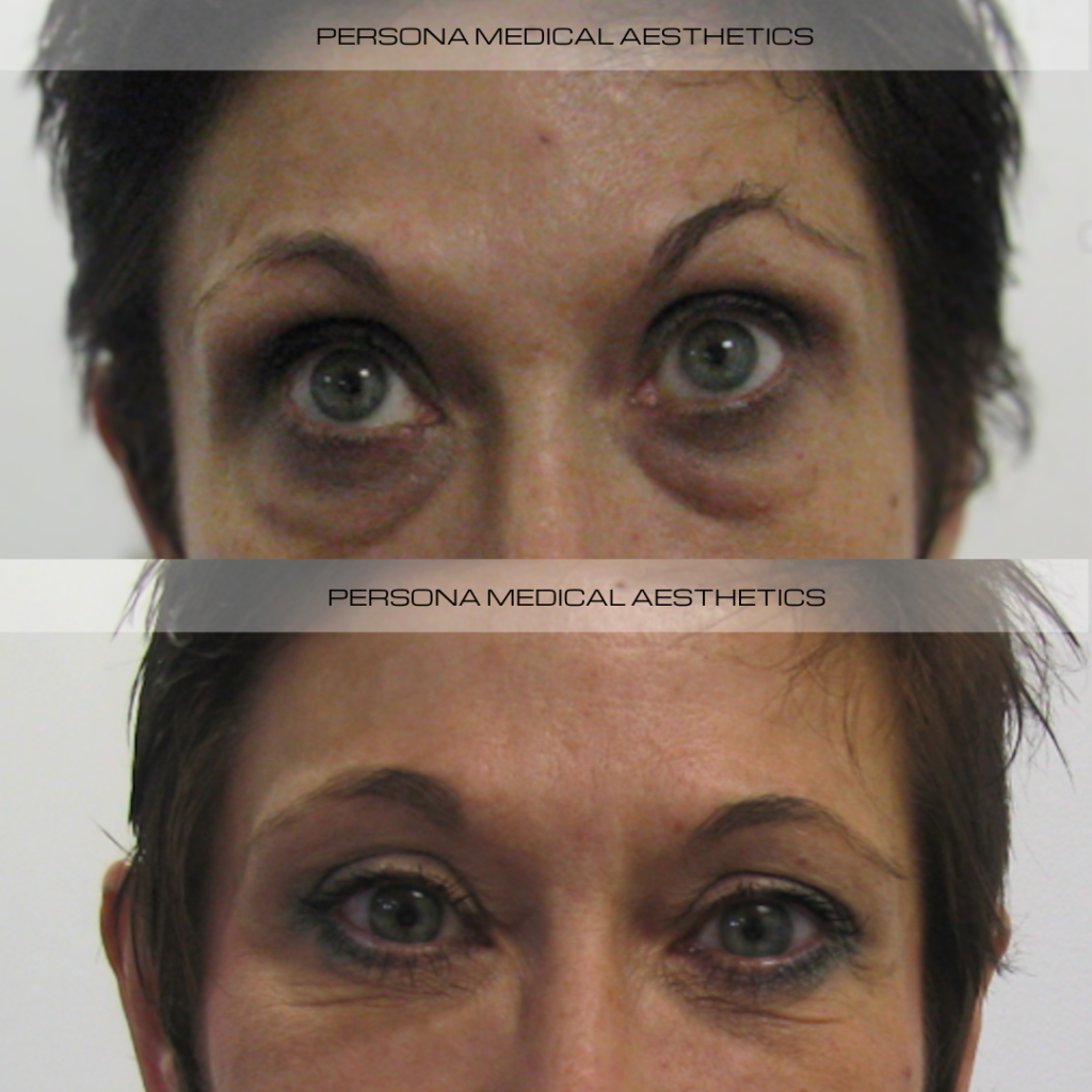 Tear trough filler is a non-surgical treatment that targets dark circles, hollowness and tired looking eyes. The ‘tear trough’ refers to the area between your lower eyelid and upper cheek. Over time, this area can lose volume, creating shadows and a sunken appearance.