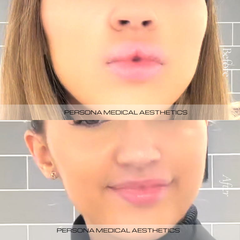 hyalase before & after