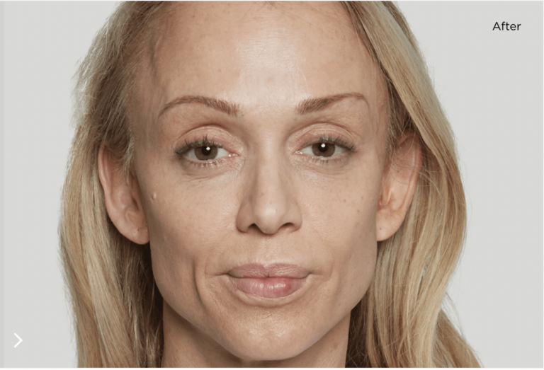 sculptra after persona medical aesthetics