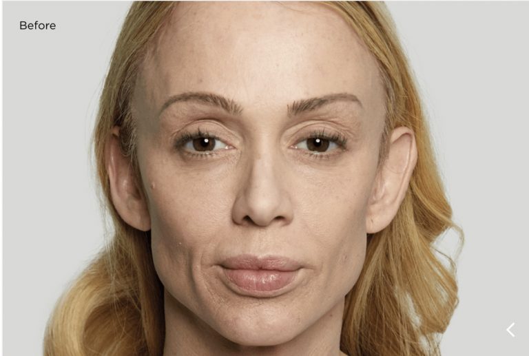 scupltra before Persona Medical Aesthetics