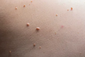 Skin Tag Removal Bexleyheath