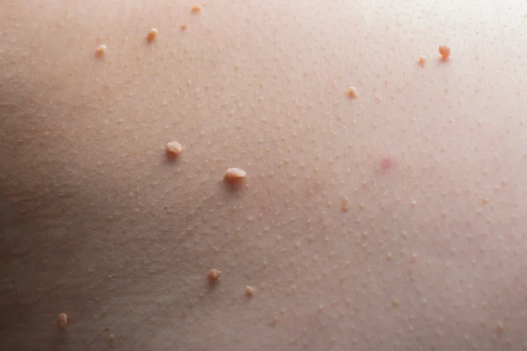 Skin Tag Removal Bexleyheath