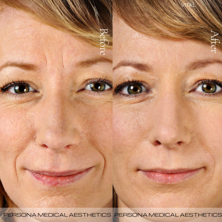 Before and After Hydrating Skin Booster