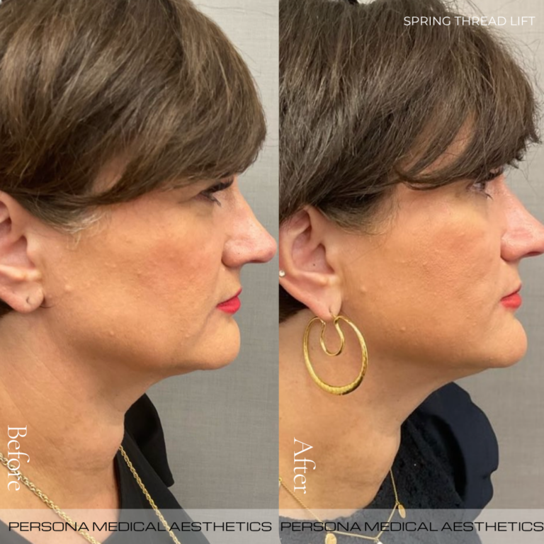 Before and After S Thread Lift