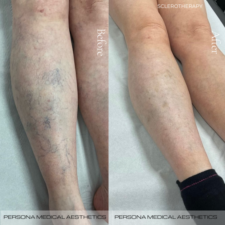 Before and After Sclerotherapy