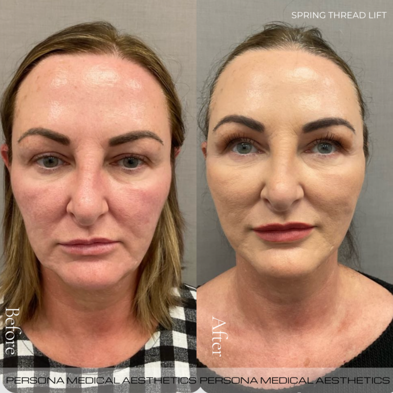 Before and After Spring Lift
