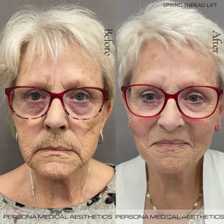Before and After Thread Lift