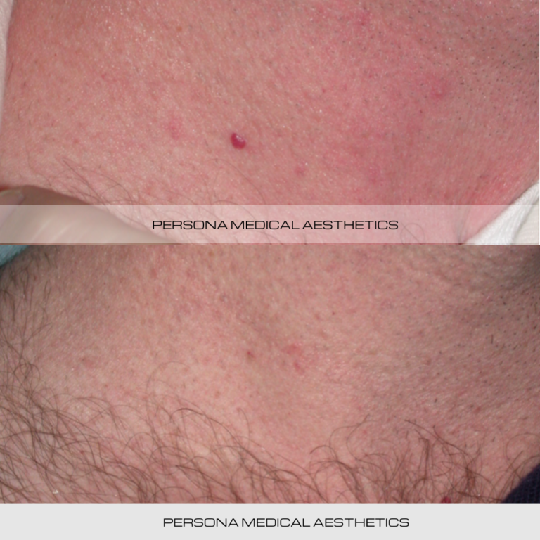 Bllod spot before & afetr