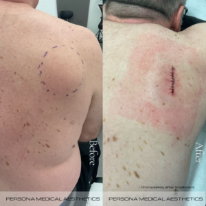 Cyst Before & after