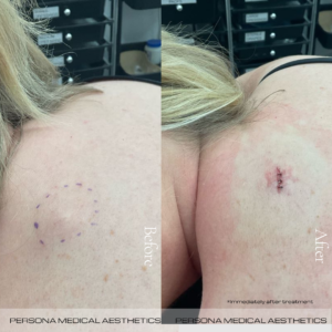 Lipoma Before & after