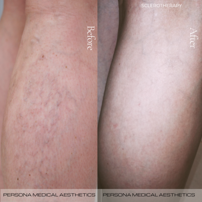 Sclero before & after