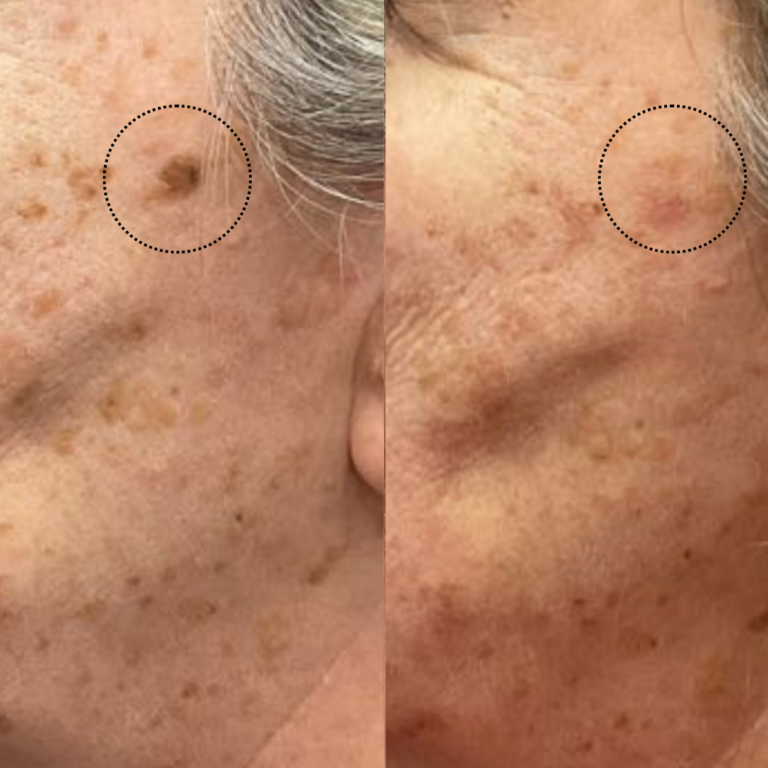 Keratosis Removal Before & After