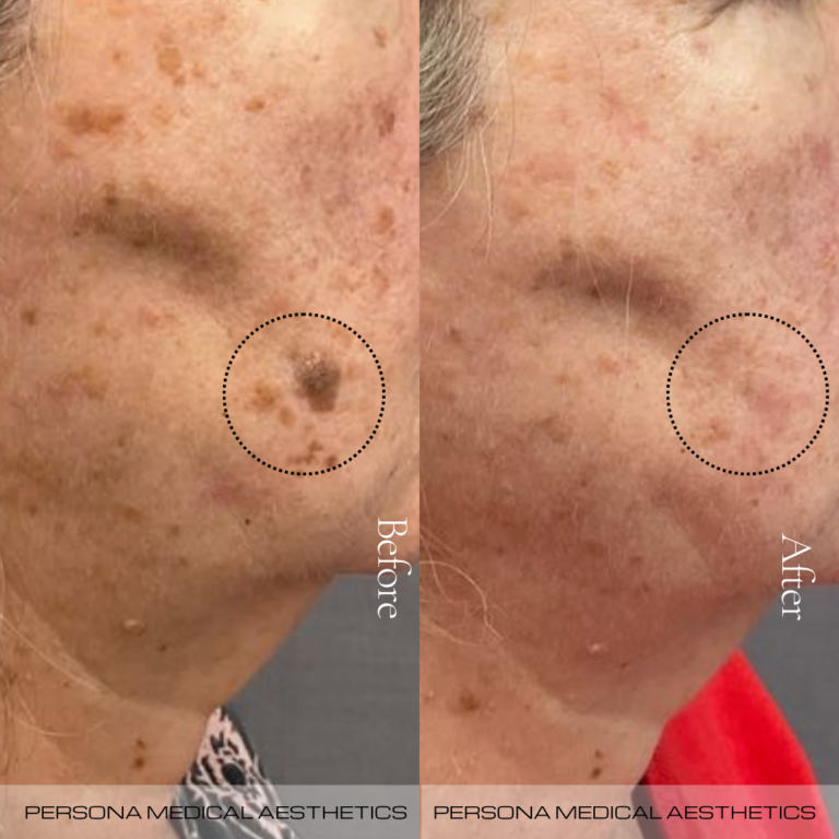 Keratosis Removal Before & After