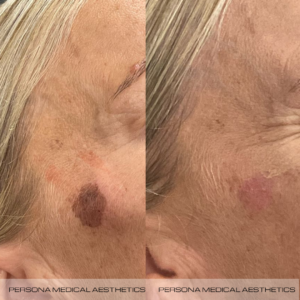 Keratosis Removal Before & After