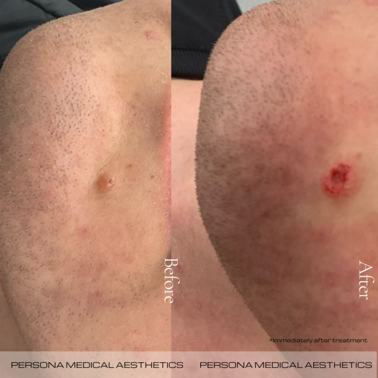 Mole Removal Before & After