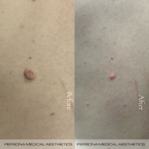 Skin Tag Removal Before & After