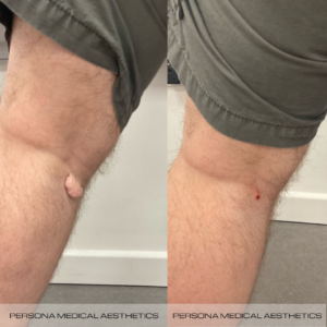 Skin Tag Removal Before & After