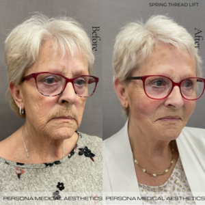 Before and after image of thread lift treatment